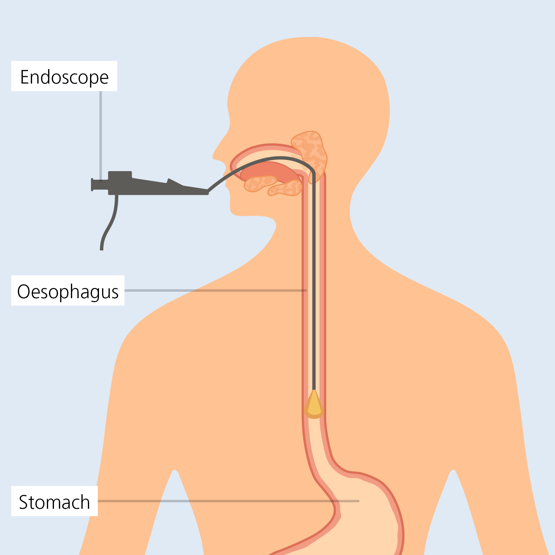 eosinophilic esophagitis EoE - endoscopic dilation