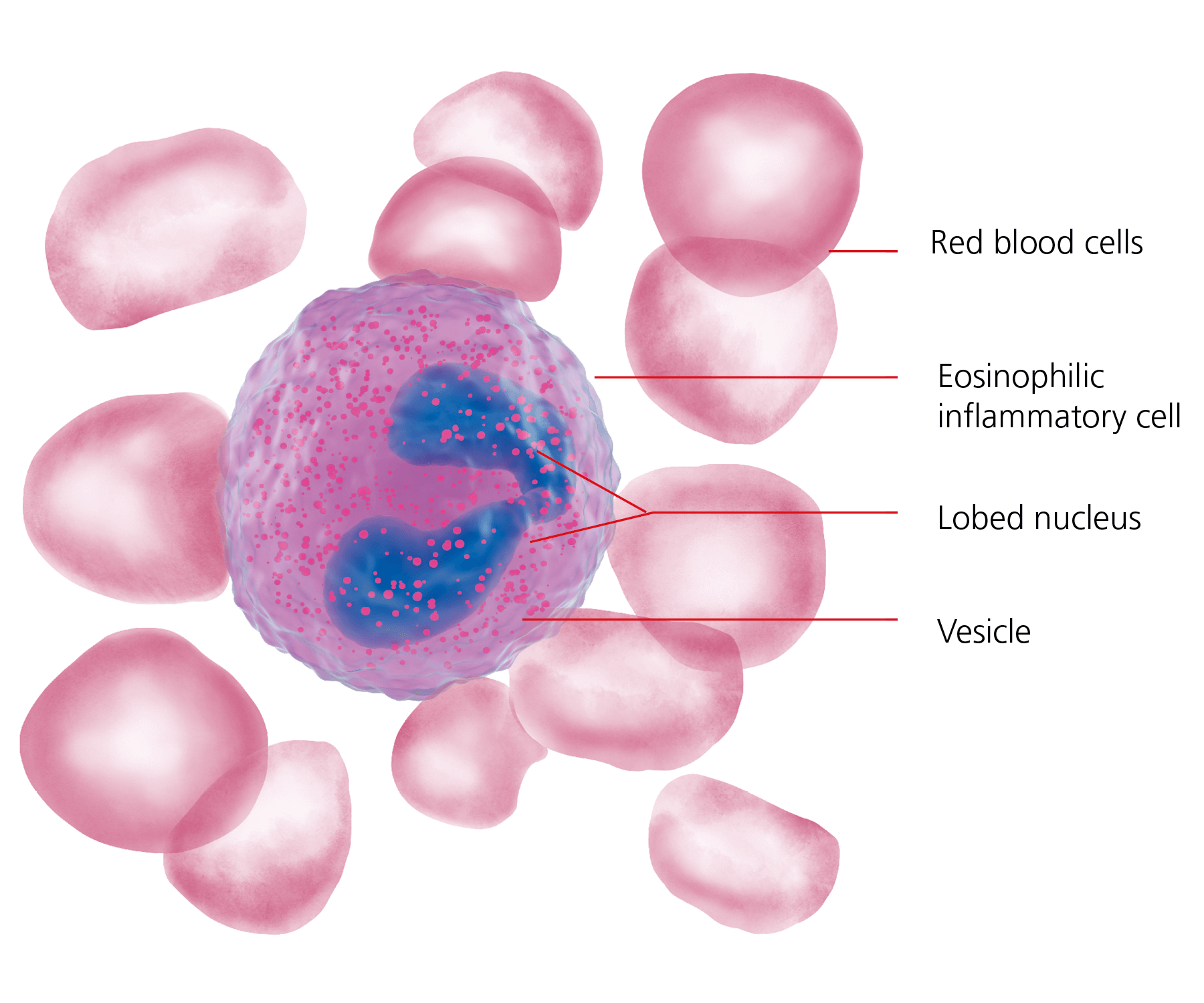 eosinophilic esophagitis EoE - eosinophil with red blood cells