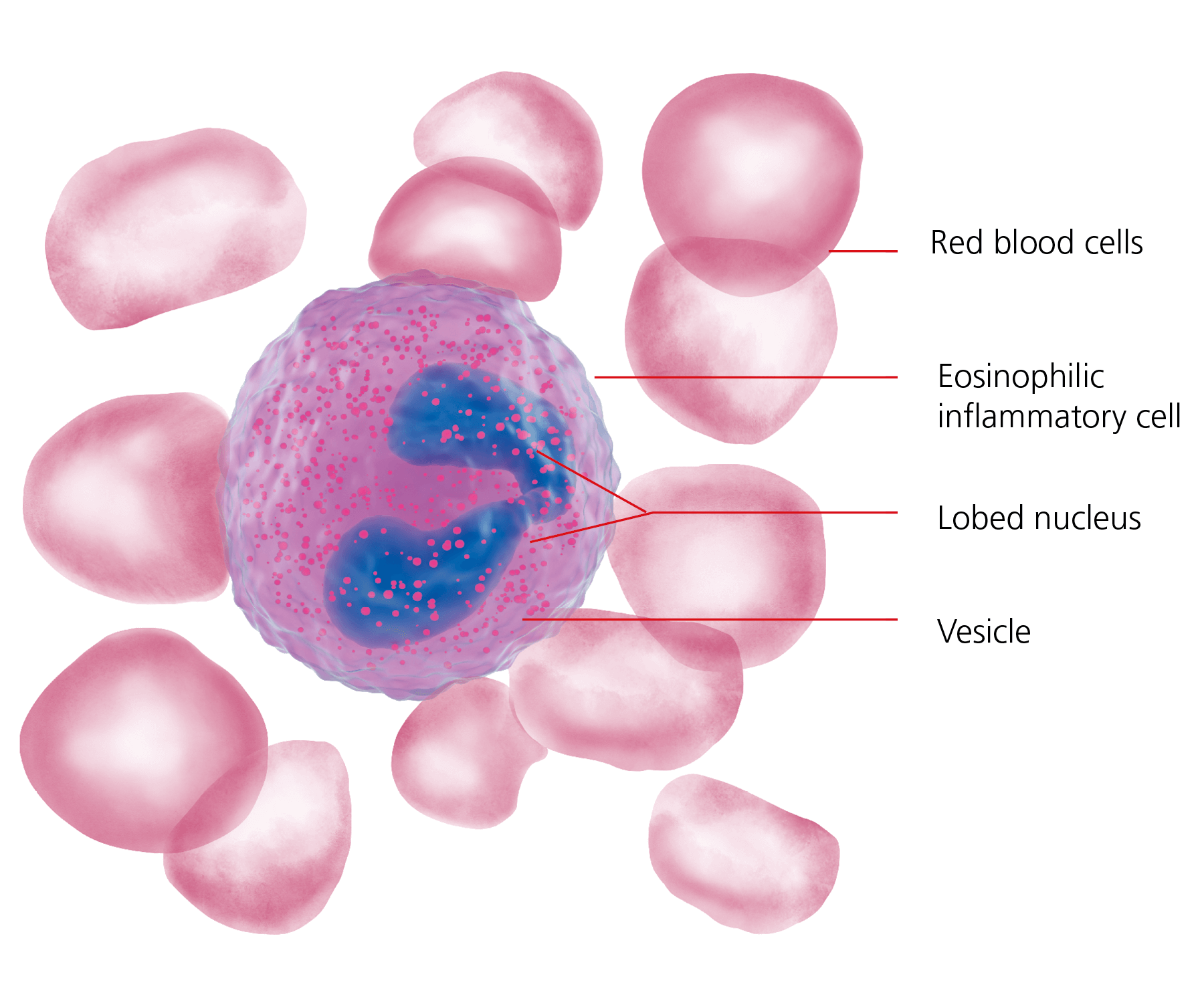 Diagnosis Eosinophilic Oesophagitis