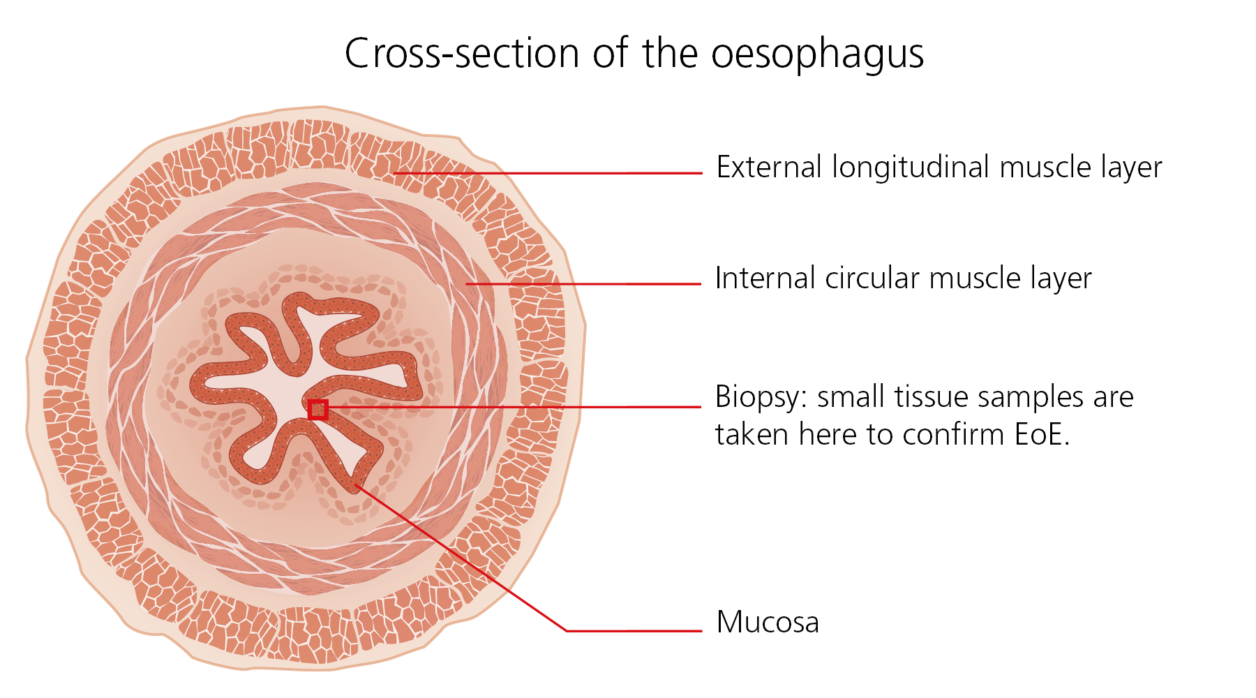 eosinophilic esophagitis EoE - cross-section of the oesophagus
